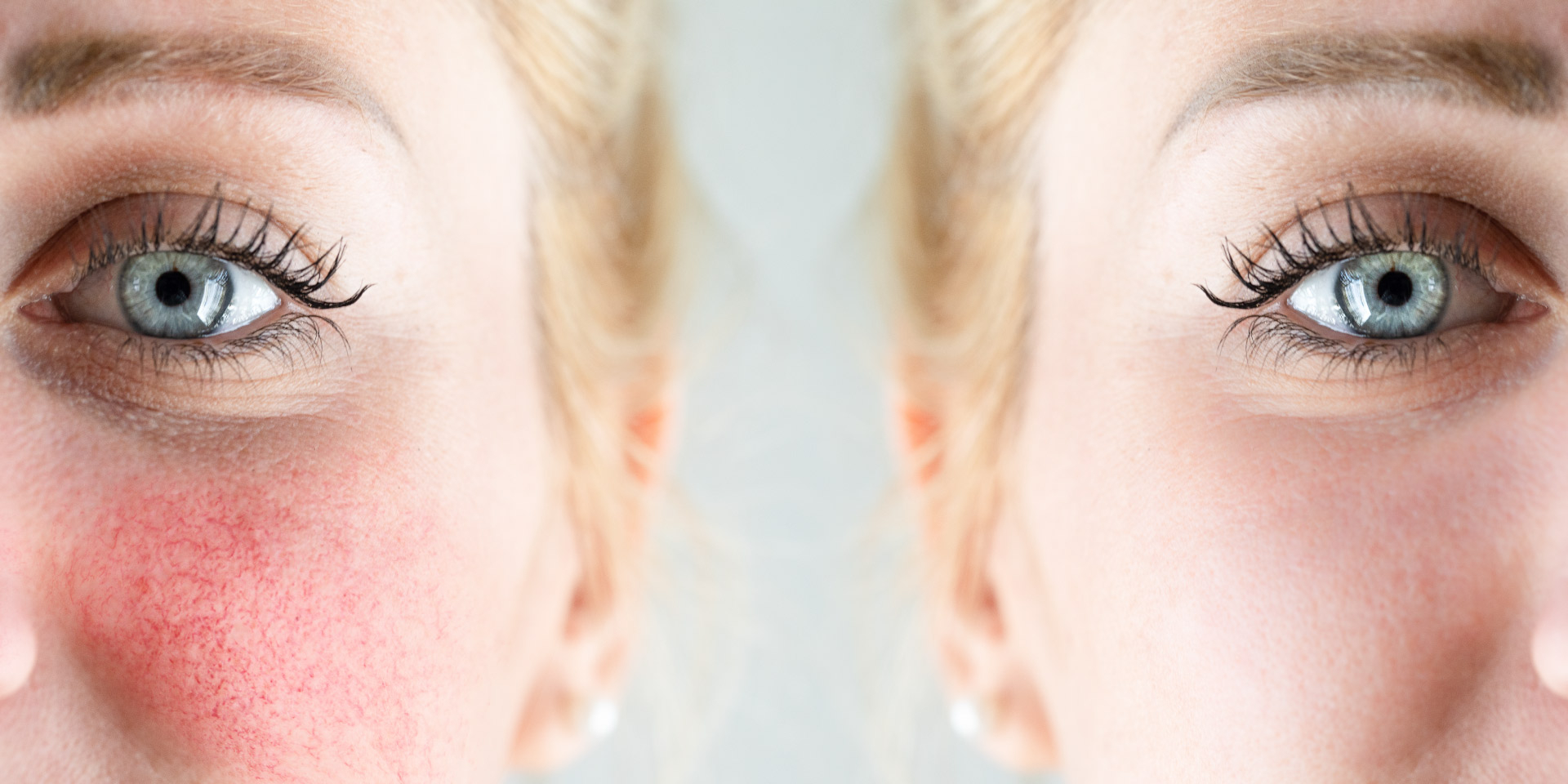 Rosácea: cómo reducir el enrojecimiento y calmar la piel en el frío Rosácea: cómo reducir el enrojecimiento y calmar la piel en el frío