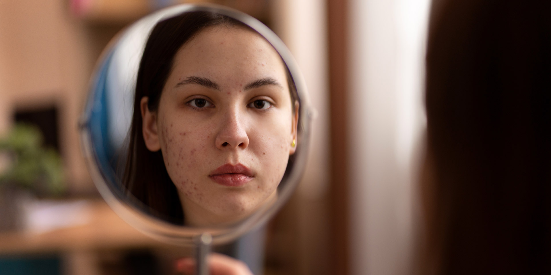 Acne hormonal: causas, tratamento e rotina recomendada